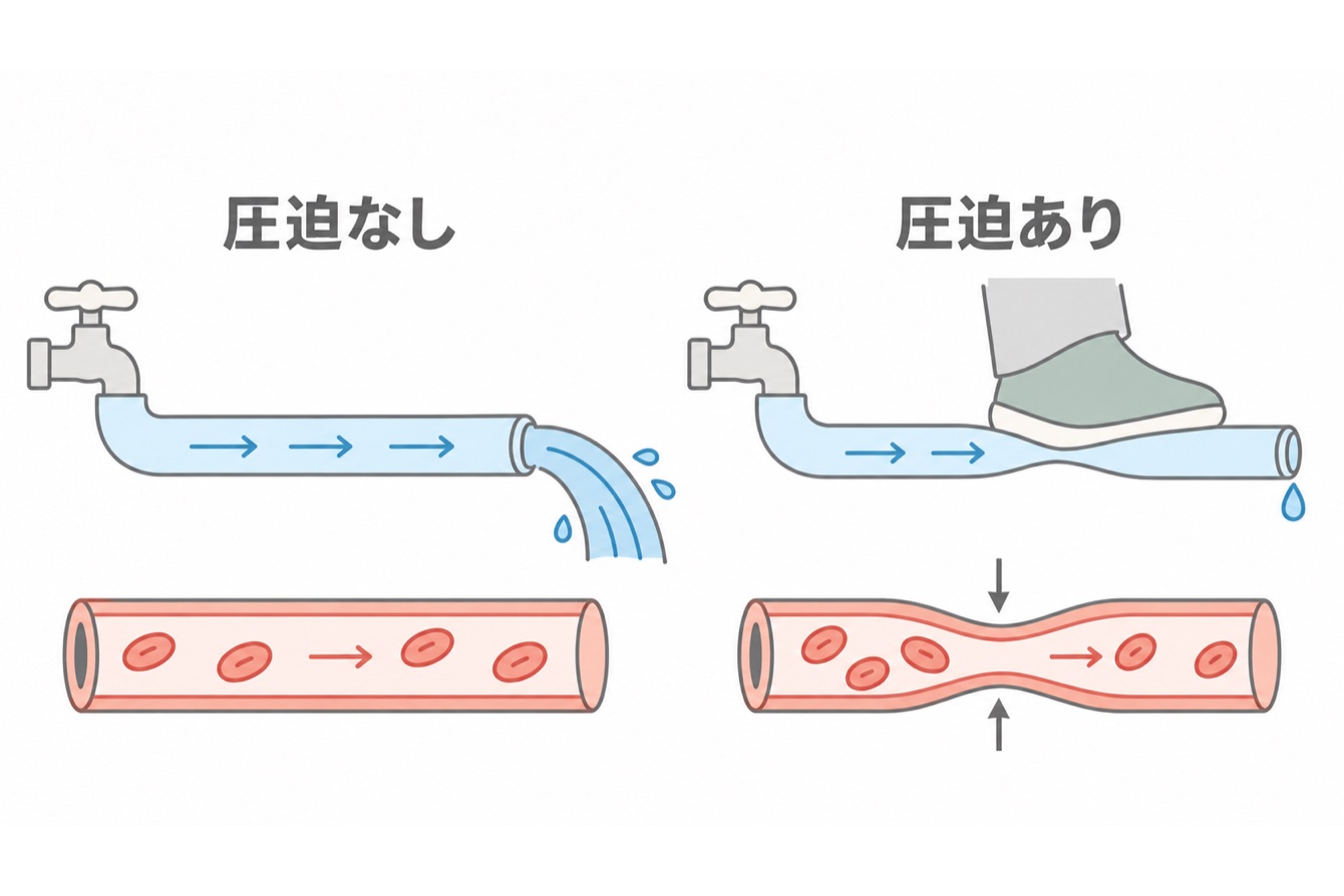 圧迫なしと圧迫ありの比較図。ホースを踏むと水の流れが悪くなるように、圧迫で血流が妨げられる